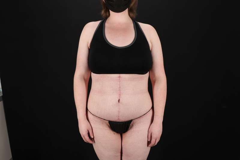 Fleur De Lis Tummy Tuck Before & After Patient #4340