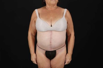 Fleur De Lis Tummy Tuck Before & After Patient #4353