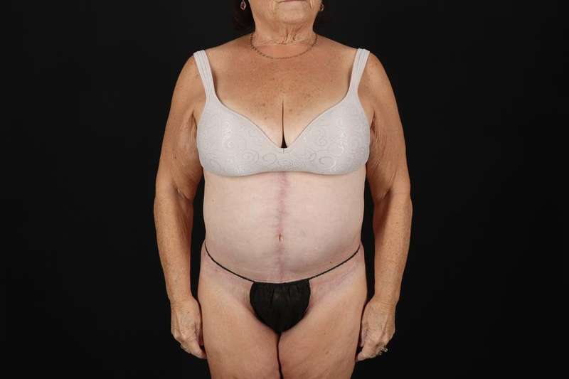 Fleur De Lis Tummy Tuck Before & After Patient #4353