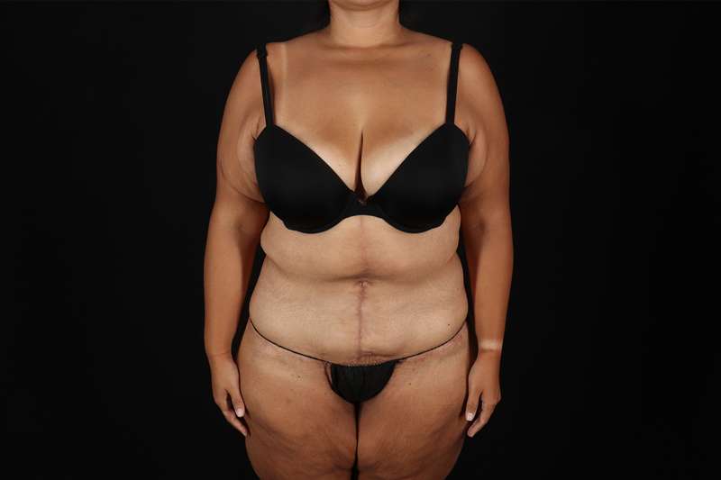 Fleur De Lis Tummy Tuck Before & After Patient #4366