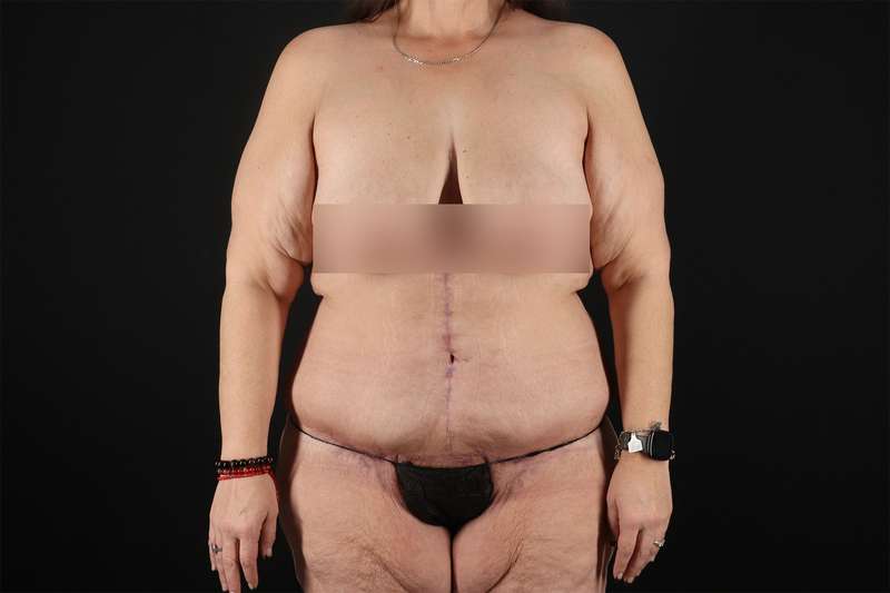 Fleur De Lis Tummy Tuck Before & After Patient #4379