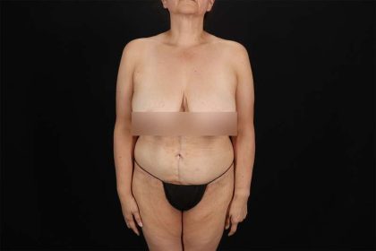 Fleur De Lis Tummy Tuck Before & After Patient #4392
