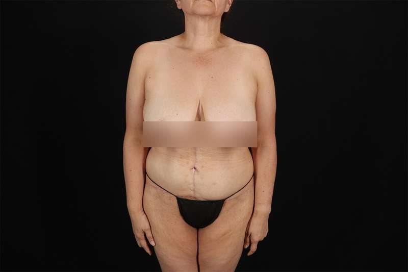 Fleur De Lis Tummy Tuck Before & After Patient #4392