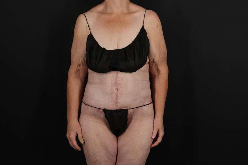 Fleur De Lis Circumferential Body Lift Before & After Patient #4210