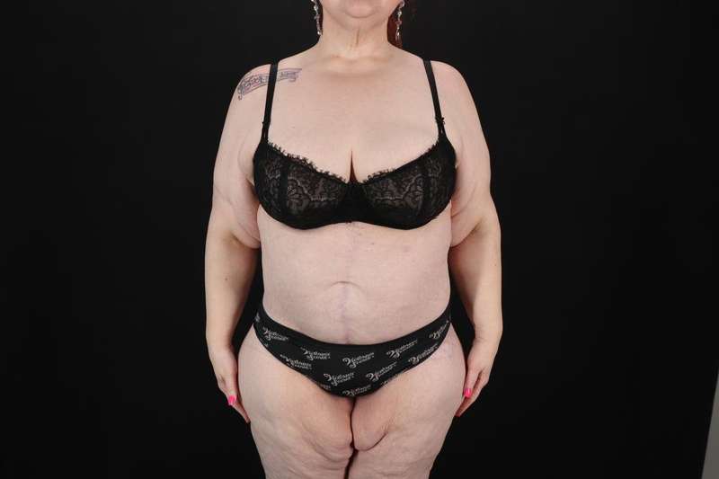 Fleur De Lis Circumferential Body Lift Before & After Patient #4236