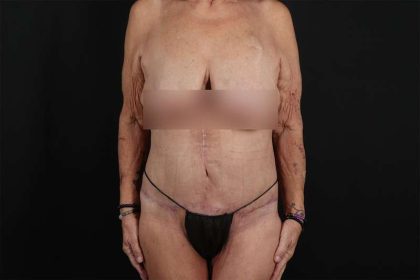 Fleur De Lis Circumferential Body Lift Before & After Patient #4262