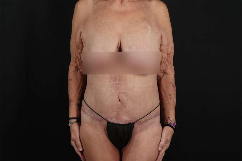 Fleur De Lis Circumferential Body Lift Before & After Patient #4262