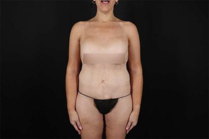 Fleur De Lis Circumferential Body Lift Before & After Patient #4288