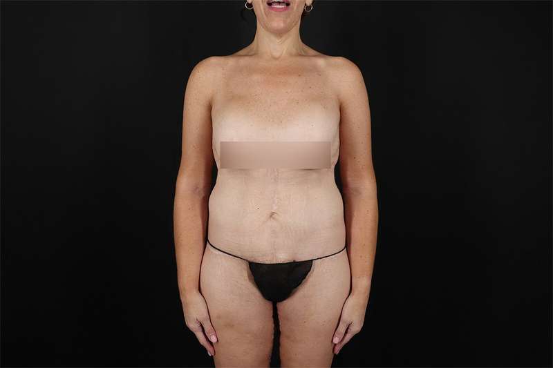 Fleur De Lis Circumferential Body Lift Before & After Patient #4288