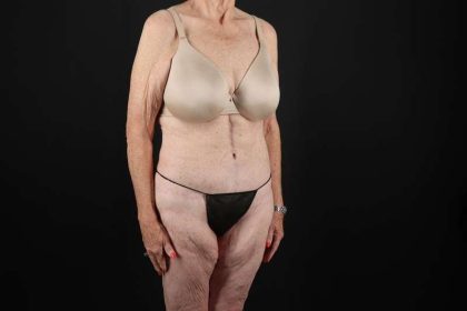 Fleur De Lis Tummy Tuck Before & After Patient #4327