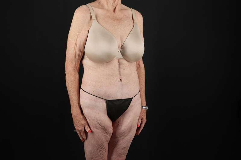 Fleur De Lis Tummy Tuck Before & After Patient #4327