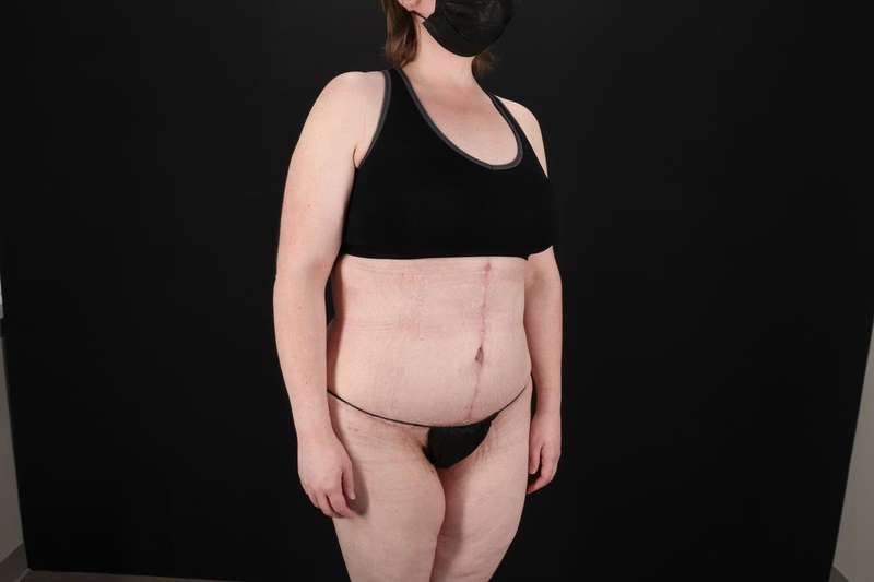 Fleur De Lis Tummy Tuck Before & After Patient #4340