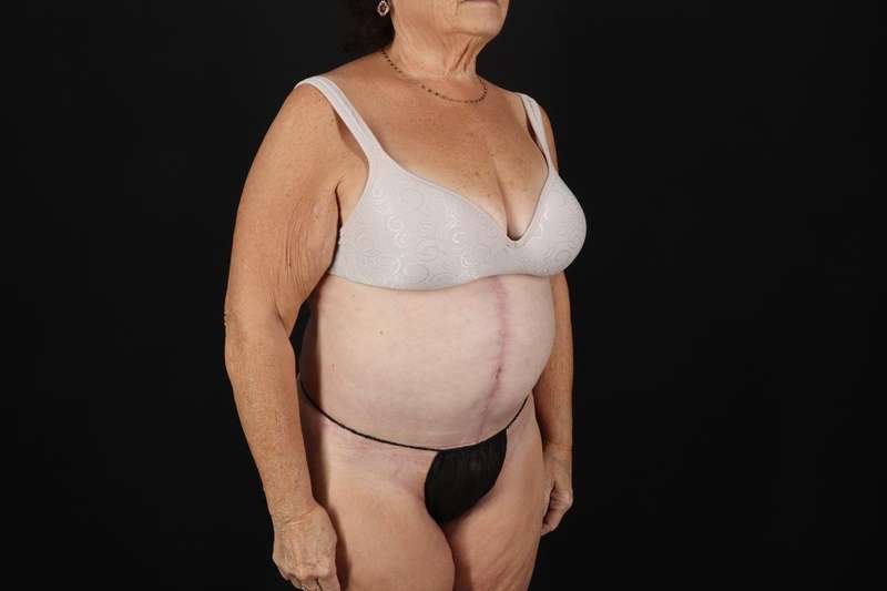 Fleur De Lis Tummy Tuck Before & After Patient #4353