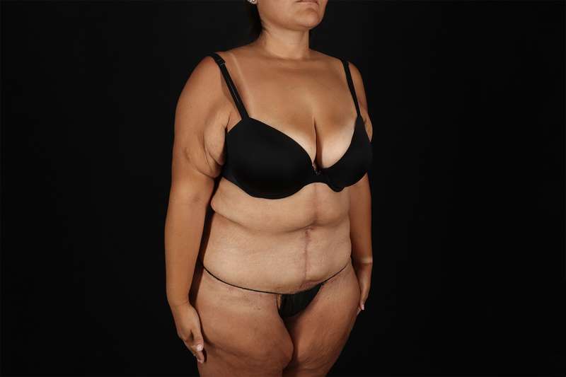 Fleur De Lis Tummy Tuck Before & After Patient #4366