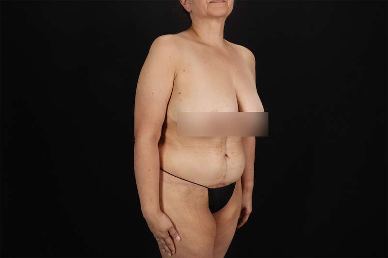 Fleur De Lis Tummy Tuck Before & After Patient #4392
