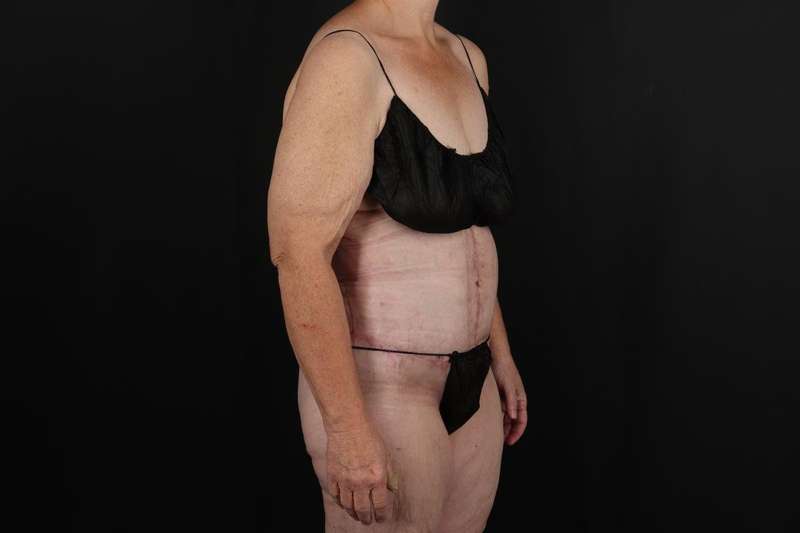 Fleur De Lis Circumferential Body Lift Before & After Patient #4210