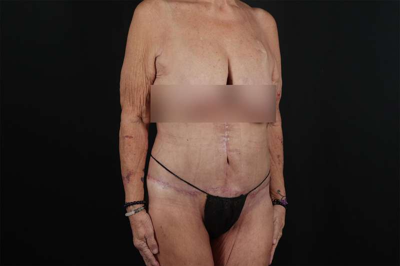 Fleur De Lis Circumferential Body Lift Before & After Patient #4262