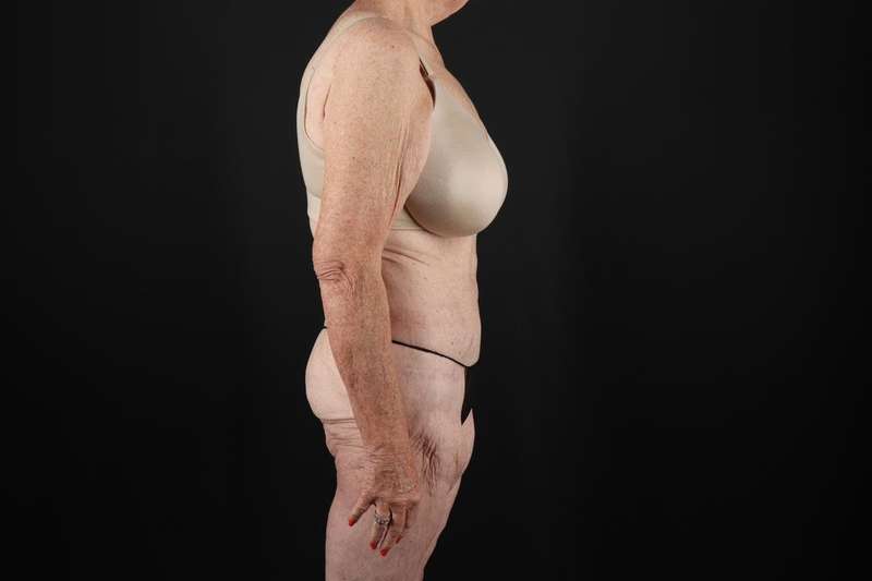 Fleur De Lis Tummy Tuck Before & After Patient #4327