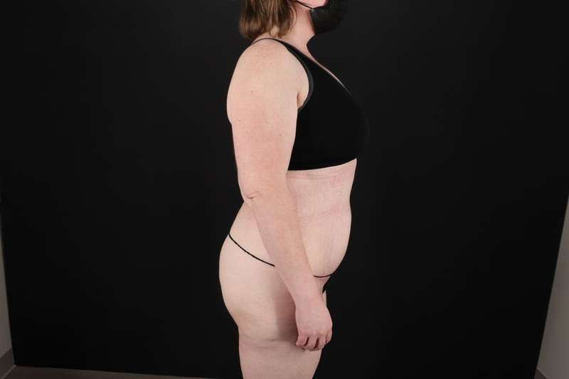 Fleur De Lis Tummy Tuck Before & After Patient #4340