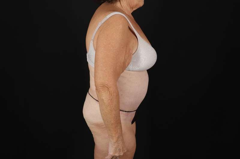 Fleur De Lis Tummy Tuck Before & After Patient #4353