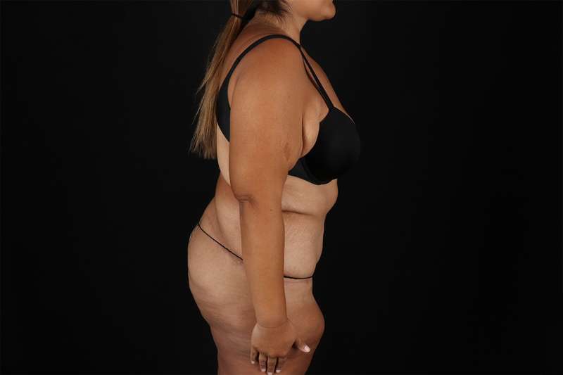 Fleur De Lis Tummy Tuck Before & After Patient #4366