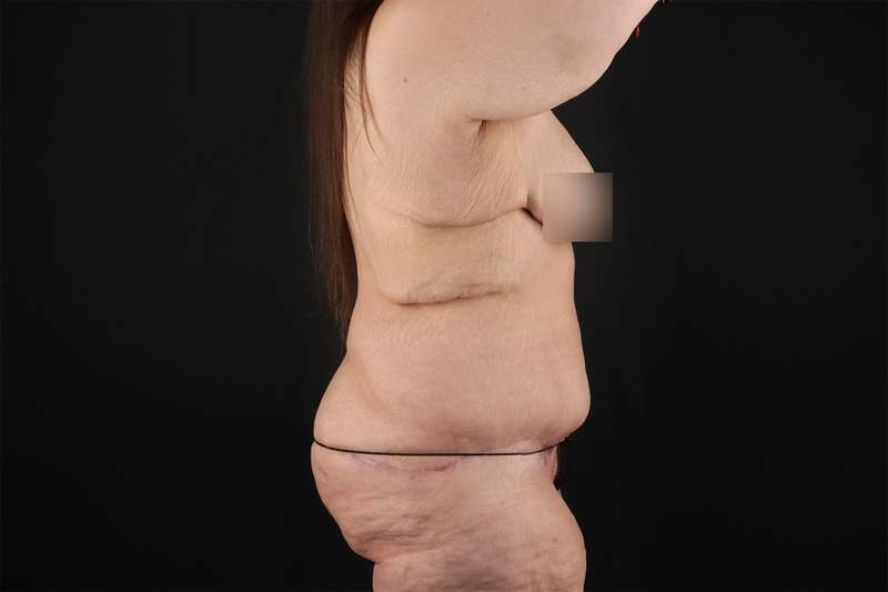 Fleur De Lis Tummy Tuck Before & After Patient #4379