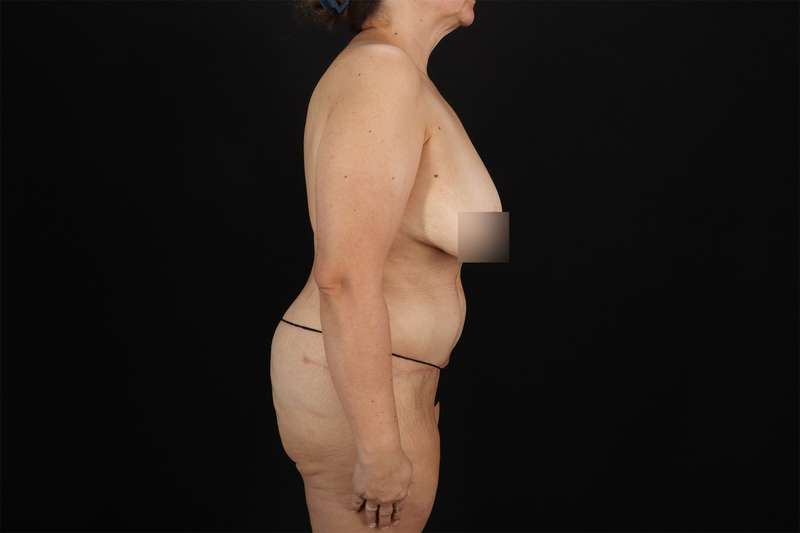 Fleur De Lis Tummy Tuck Before & After Patient #4392