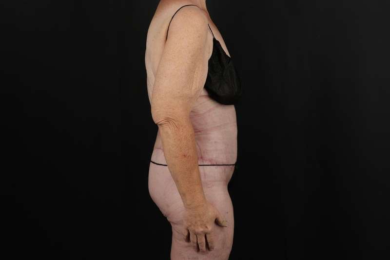 Fleur De Lis Circumferential Body Lift Before & After Patient #4210