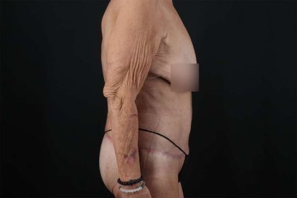 Fleur De Lis Circumferential Body Lift Before & After Patient #4262