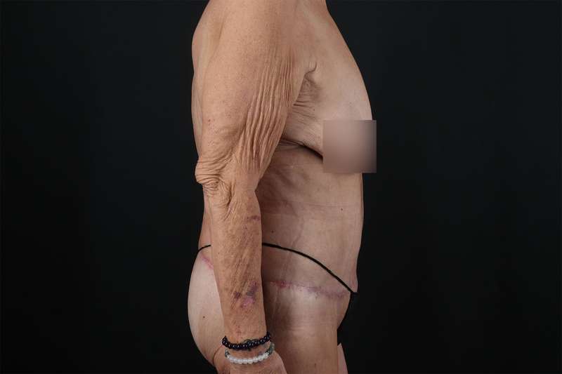 Fleur De Lis Circumferential Body Lift Before & After Patient #4262