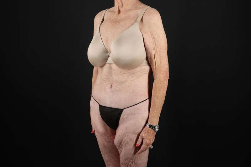 Fleur De Lis Tummy Tuck Before & After Patient #4327
