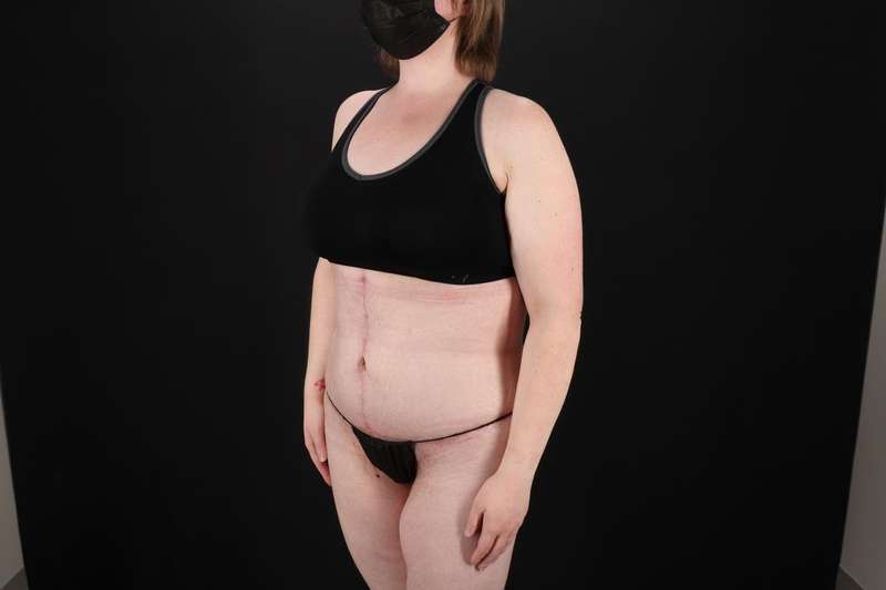 Fleur De Lis Tummy Tuck Before & After Patient #4340