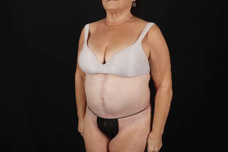 Fleur De Lis Tummy Tuck Before & After Patient #4353