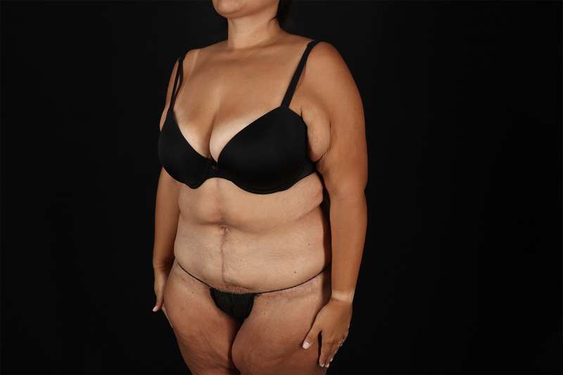Fleur De Lis Tummy Tuck Before & After Patient #4366