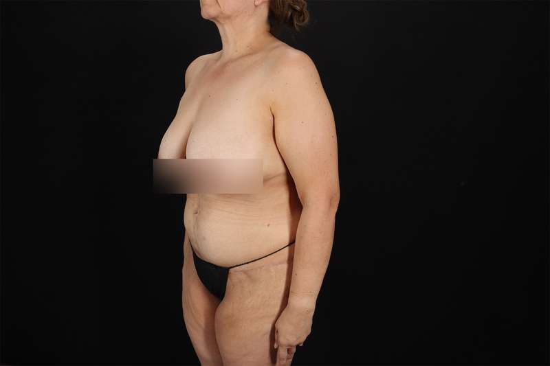 Fleur De Lis Tummy Tuck Before & After Patient #4392