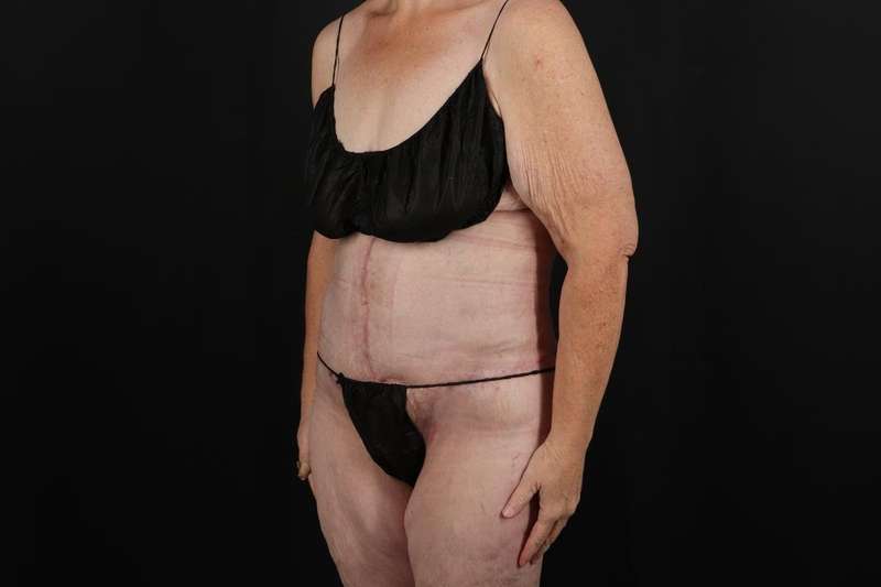 Fleur De Lis Circumferential Body Lift Before & After Patient #4210