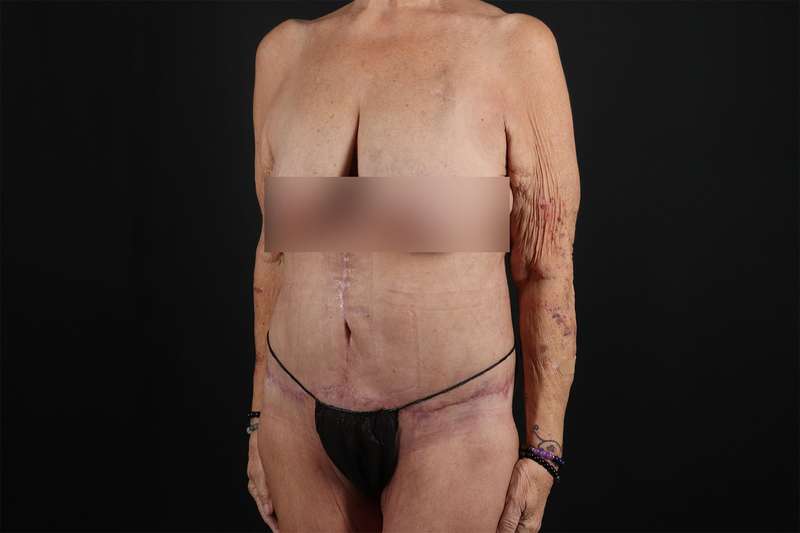 Fleur De Lis Circumferential Body Lift Before & After Patient #4262
