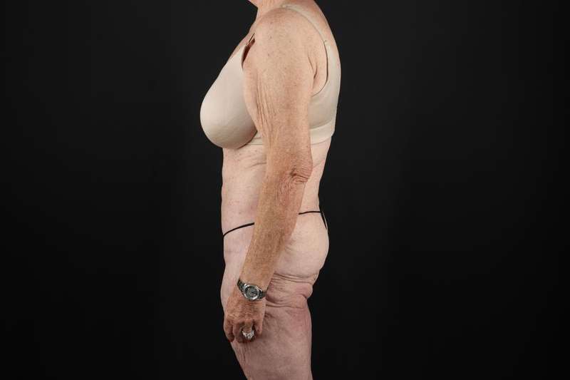 Fleur De Lis Tummy Tuck Before & After Patient #4327