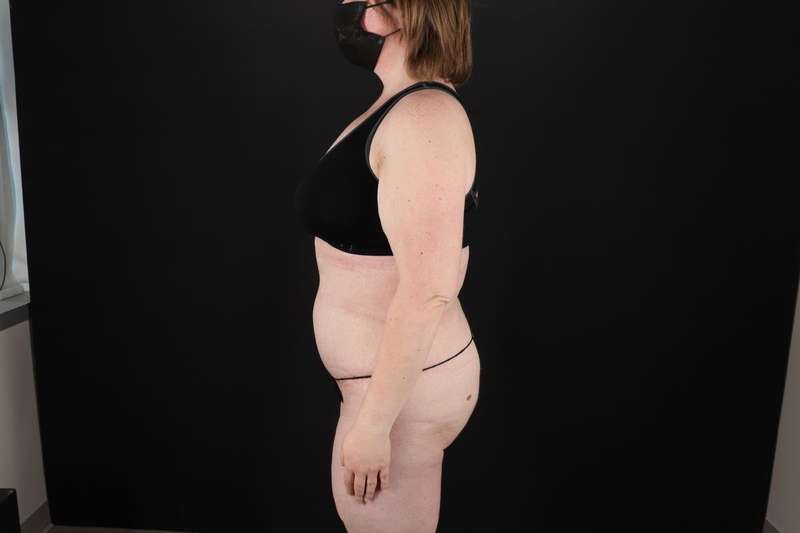 Fleur De Lis Tummy Tuck Before & After Patient #4340
