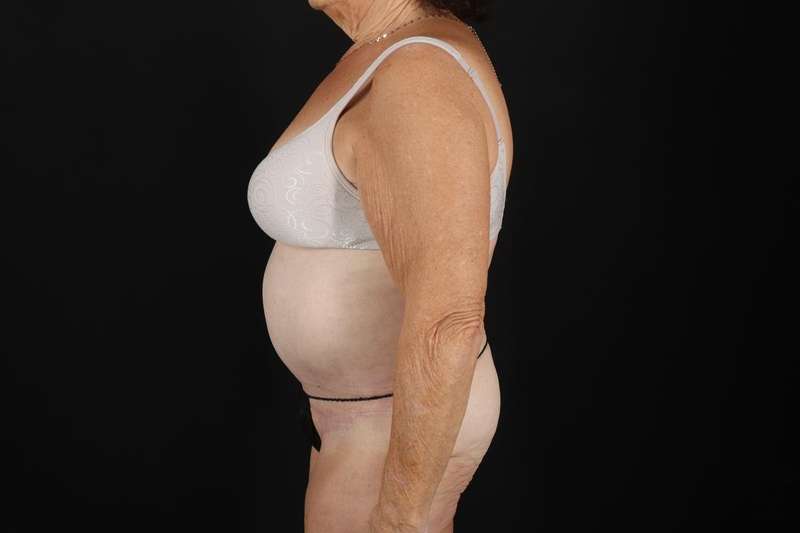 Fleur De Lis Tummy Tuck Before & After Patient #4353