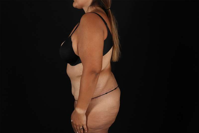 Fleur De Lis Tummy Tuck Before & After Patient #4366