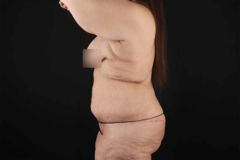 Fleur De Lis Tummy Tuck Before & After Patient #4379