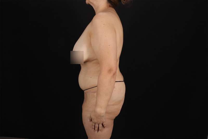 Fleur De Lis Tummy Tuck Before & After Patient #4392