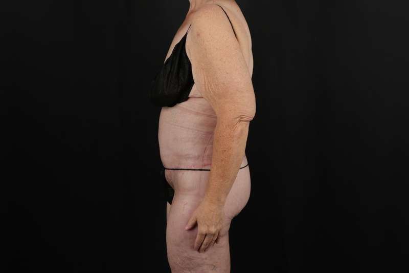 Fleur De Lis Circumferential Body Lift Before & After Patient #4210