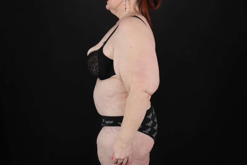 Fleur De Lis Circumferential Body Lift Before & After Patient #4236