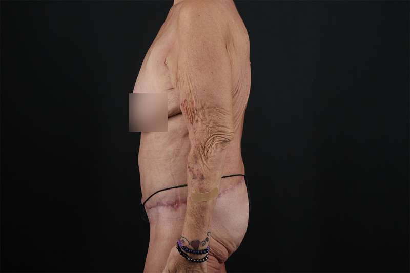 Fleur De Lis Circumferential Body Lift Before & After Patient #4262