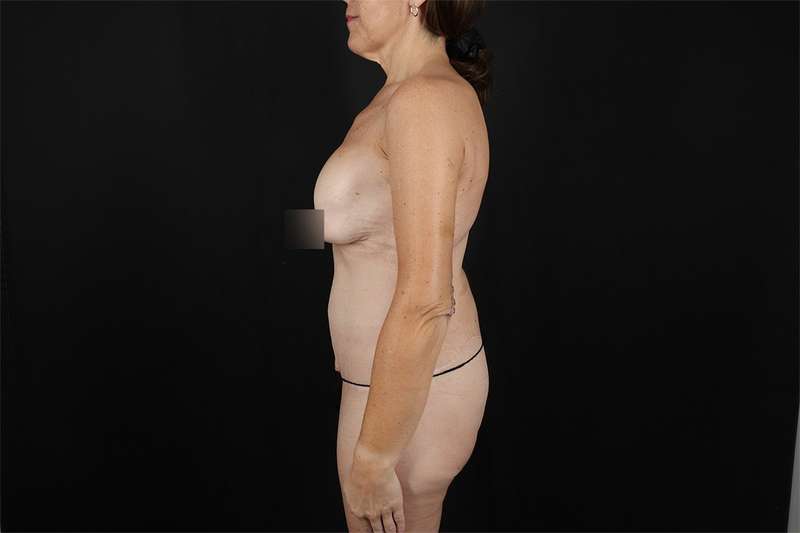Fleur De Lis Circumferential Body Lift Before & After Patient #4288