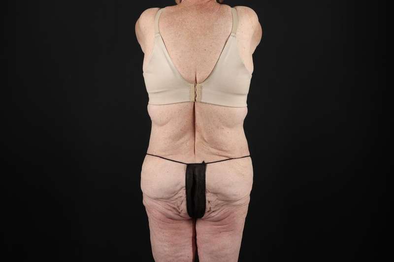 Fleur De Lis Tummy Tuck Before & After Patient #4327