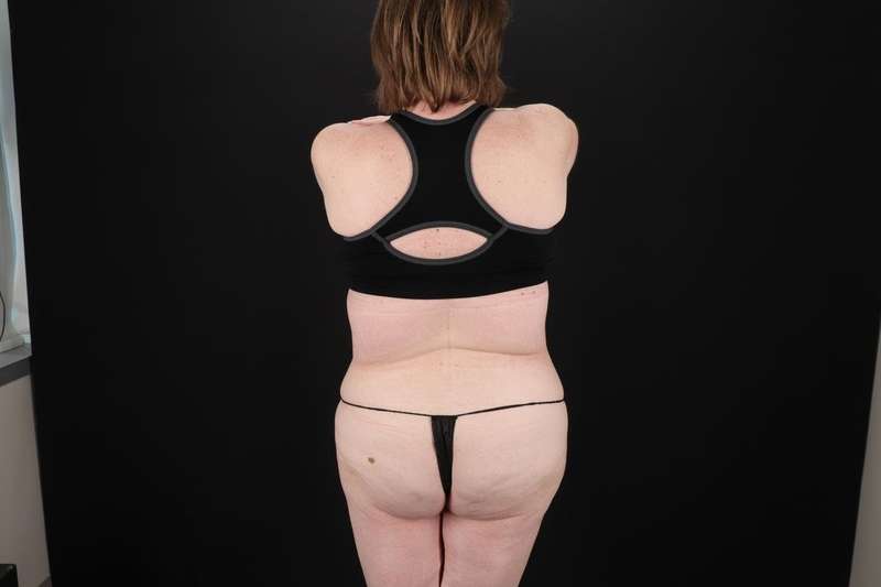 Fleur De Lis Tummy Tuck Before & After Patient #4340