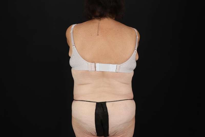 Fleur De Lis Tummy Tuck Before & After Patient #4353